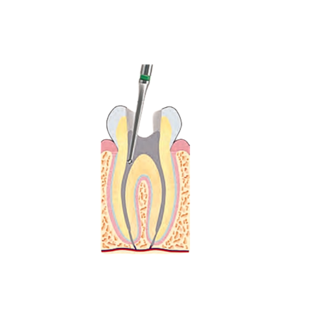 H1SNL - Foret de Müller Endo-1
