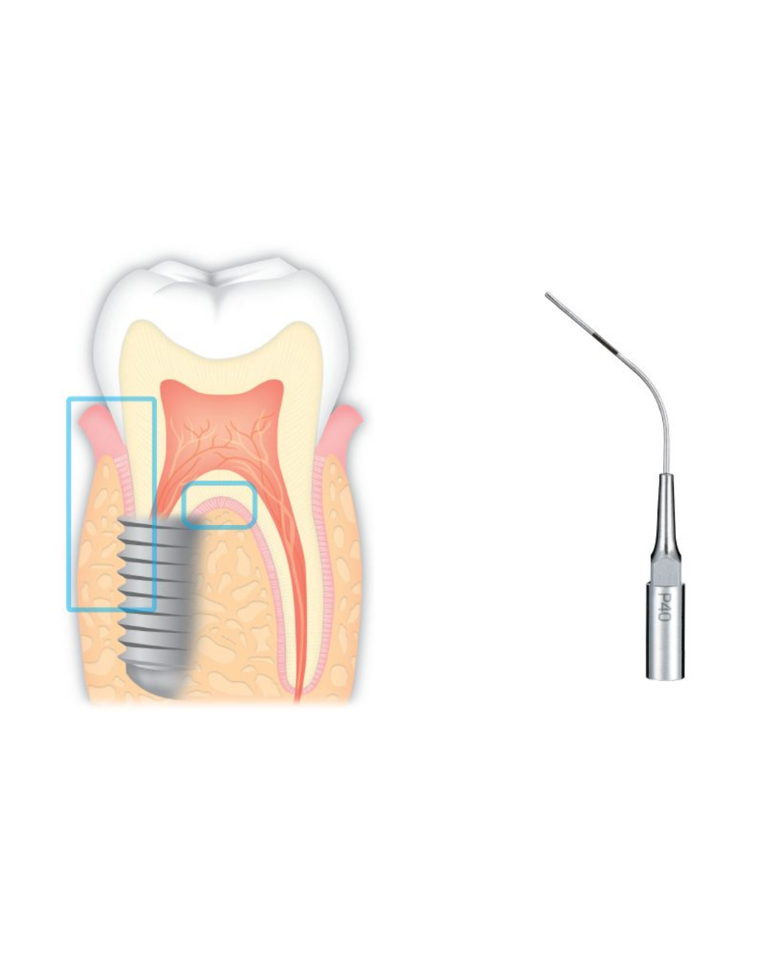 Insert Ultrasonique – Pério (Irrigation et nettoyage) - P40-1